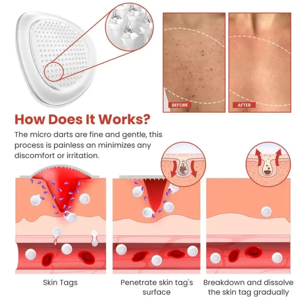 Derma Smooth Skin Tag Removal Patches