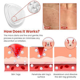 Derma Smooth Skin Tag Removal Patches