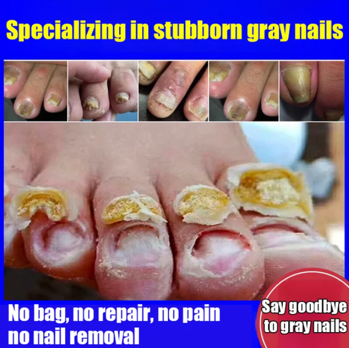 Fungal Nail Treatment Cream