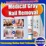 Fungal Nail Treatment Cream
