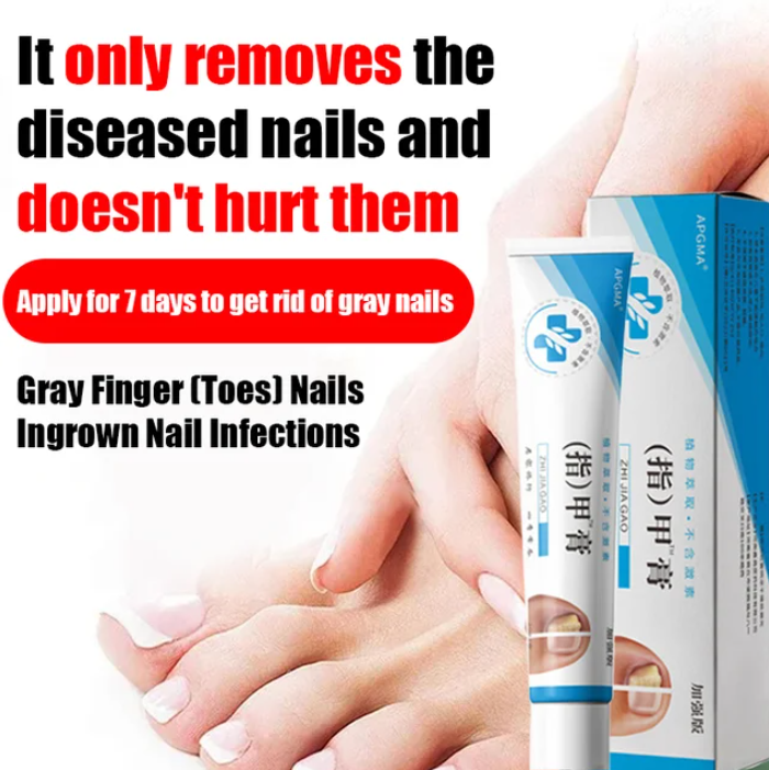 Fungal Nail Treatment Cream