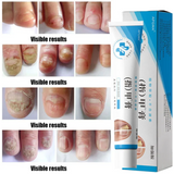 Fungal Nail Treatment Cream