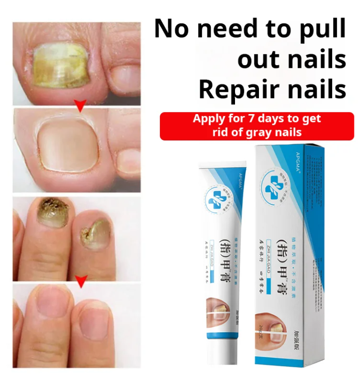 Fungal Nail Treatment Cream